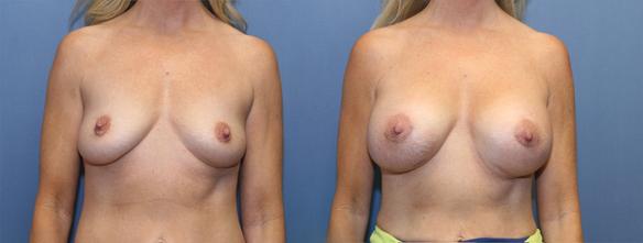 D cup size breast augmentation Beverly :HIlls